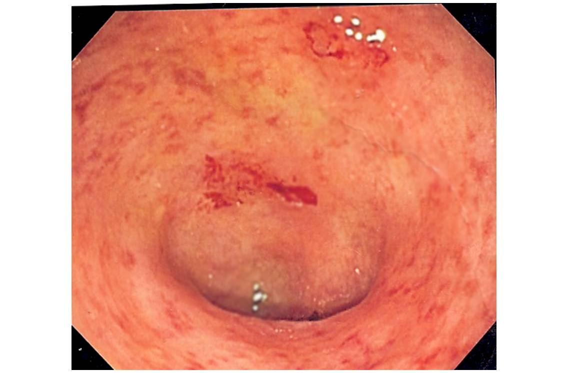 Image endoscopique d'une partie des intestins (côlon sigmoïde) atteinte de rectocolite hémorragique (@ Wikimedia). 