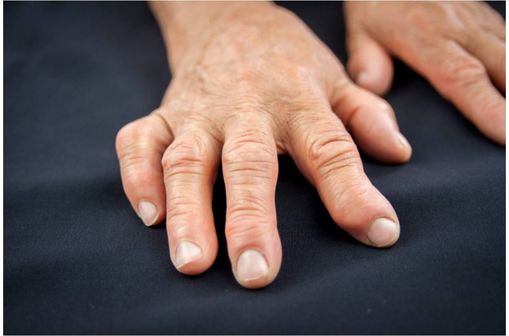 Déformation des doigts dans un contexte de polyarthrite rhumatoïde.