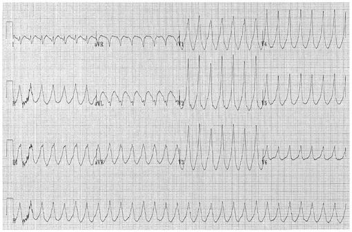 Tracé électrocardiographique de tachycardie ventriculaire (illustration @ Dr Karthik Sheka, sur Wikimedia).
