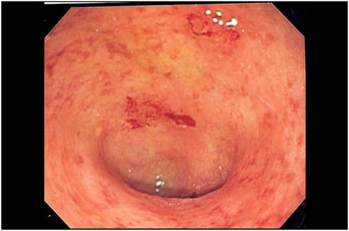 Image endoscopique de lésions de rectocolite hémorragique localisées au niveau du côlon sigmoïde (cliché @ UC granularity sur Wikimedia).