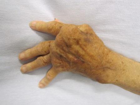Main affectée par la polyarthrite rhumatoïde (© Wikimedia - Auteur : Dr James Heilman).