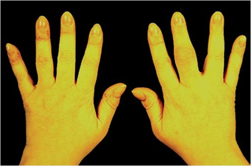 Rhumatisme psoriasique, forme oligoarticulaire avec atteinte du majeur de la main droite (© NEJM).  
