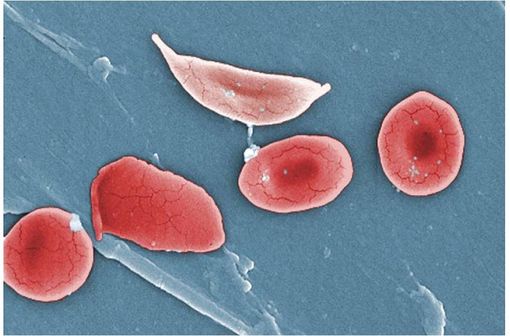 Globule rouge falciforme (pâle, en haut), typique de la drépanocytose (illustration @OpenStax College, sur Wikimedia).