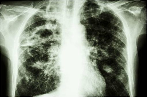 Radiographie de poumons montrant des lésions tuberculeuses (illustration).