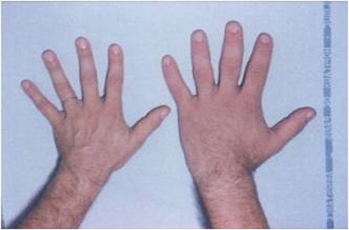 Comparaison entre une main normale (à gauche) et une main d'un patient atteint d'acromégalie (à droite) [illustration @Philippe Chanson et Sylvie Salenave sur Wikimedia].