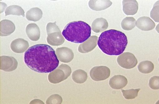 Frottis sanguin d'un patient atteint de LAL avec blastes (cellules leucémiques), coloration de Pappenheim (illustration @ Christaras A. sur Wikimedia). width=
