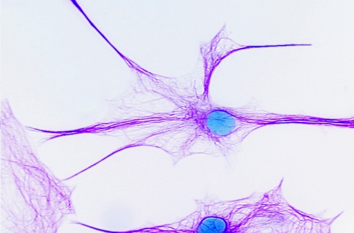 L’amyotrophie spinale (ASA ou SMA) est une maladie neuromusculaire progressive d’origine génétique, caractérisée par une dégénérescence des motoneurones (illustration). 