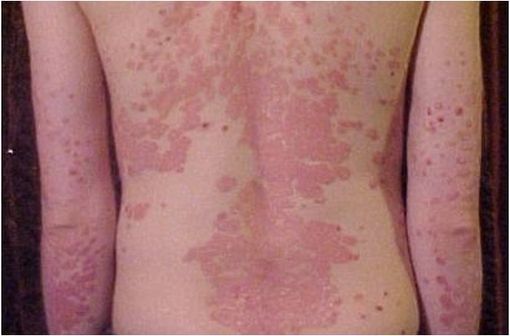 Lésions de psoriasis en plaques sévère localisées au dos d'une adolescente (illustration @Dr James Heilman, sur Wikimedia).