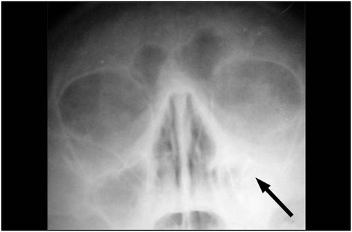 Radiographie de sinusite maxillaire gauche (illustration @Alex Khimich, sur Wikimedia).