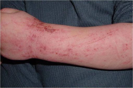 Lésions de dermatite atopique (illustration @Eisfelder sur Wikimédia).