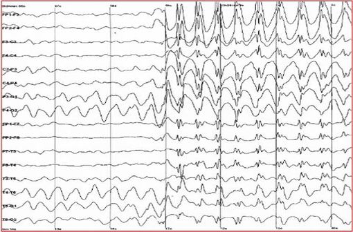 L'EEG des patients atteints de syndrome de Lennox-Gastaut est très altéré avec des anomalies intercritiques bifrontales et nombreuses, des pointes ondes généralisées (illustration @wikimedia).