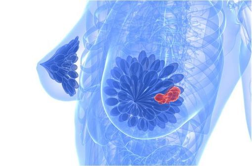 Le docétaxel peut de nouveau être prescrit dans le cancer du sein infiltrant non métastatique (illustration).