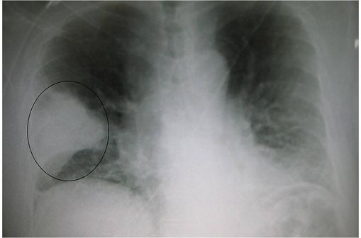 Radiographie du thorax montrant une pneumonie franche lobaire aiguë dans le poumon droit (photo @ Dr James Heilman, sur Wikimedia). 
