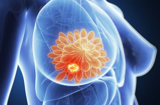 Représentation en 3D d'un cancer du sein (illustration).