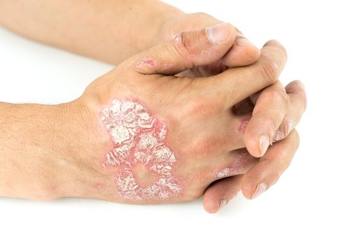 Lésions de psoriasis sur les mains d'un patient (illustration).