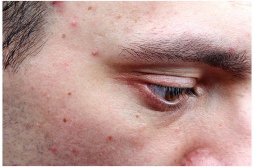 Le plus souvent primitive, l'acné marquerait l'adolescence de 85 % des gens, toutes ethnies confondues.