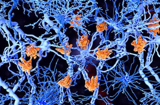 La SEP est une maladie inflammatoire et dégénérative du cerveau et de la moelle épinière qui entraîne la destruction de la gaine de myéline isolante autour des axones des neurones et la perte de la fonction nerveuse (illustration).