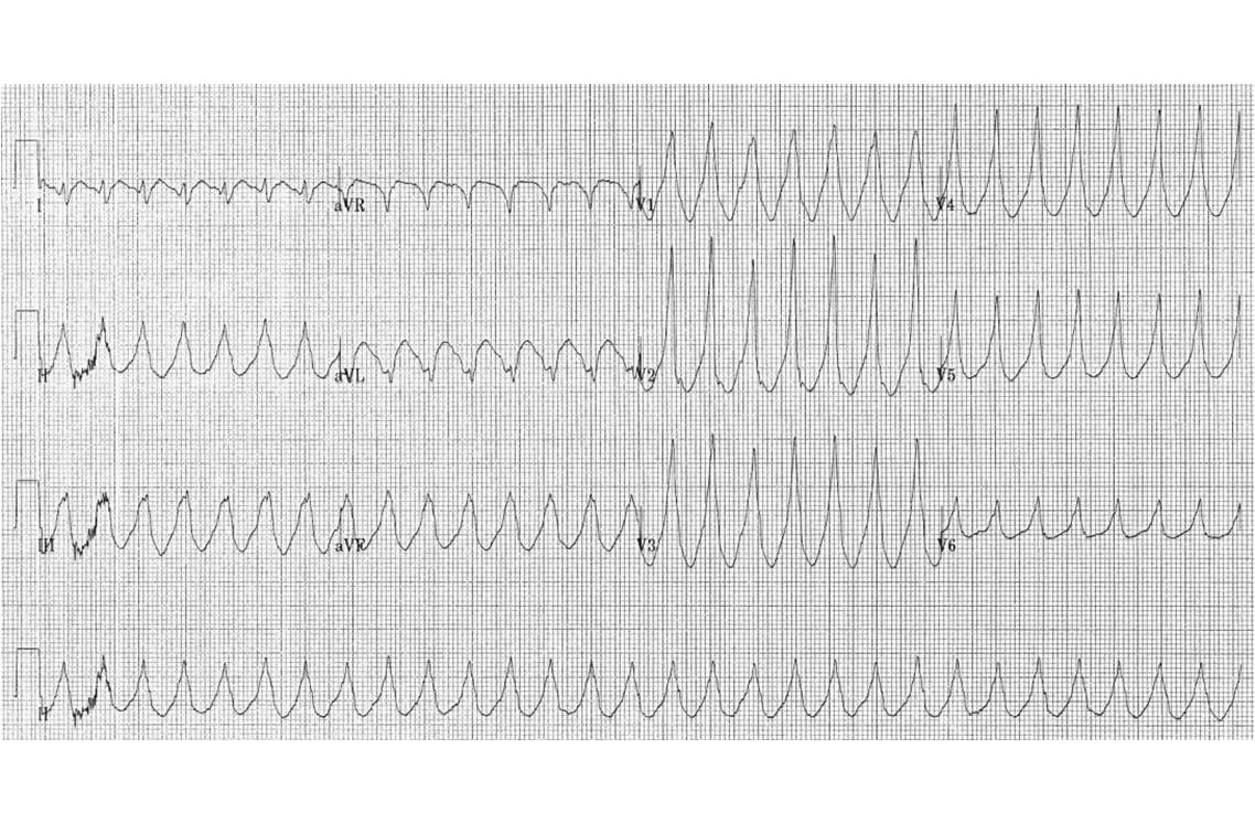 Tracé ECG de tachycardie ventriculaire (@ Ksheka, Wikimedia).