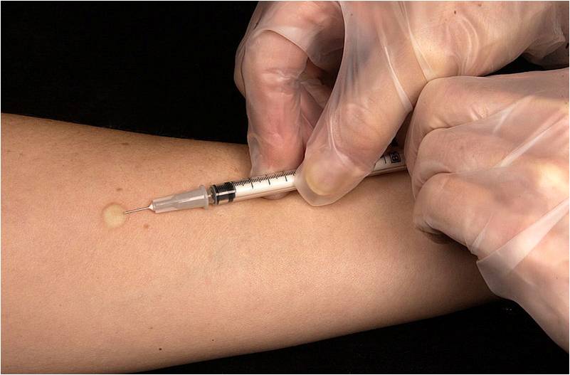 Test de sensibilité à la tuberculine ou test Mantoux, pour le dépistage de la tuberculose (@ Greg Knobloch, Wikimedia).