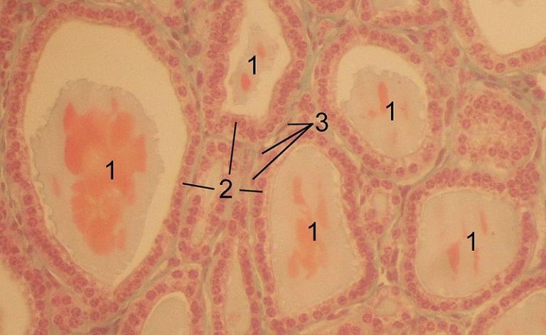 Coupe histologique de glande thyroïde (1 : follicules, 2 : cellules épithéliales folliculaires, 3 : cellules endothéliales) (© Wikipedia)