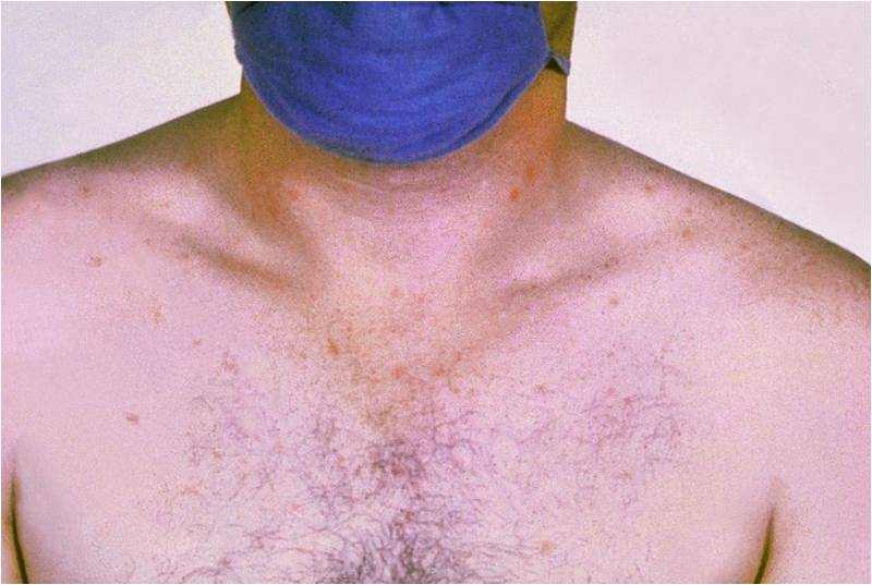 Taches rose sur la poitrine d'un patient atteint de la typhoïde (@ CDC/Armed Forces Institute of Pathology, Charles N. Farmer, Wikimedia).