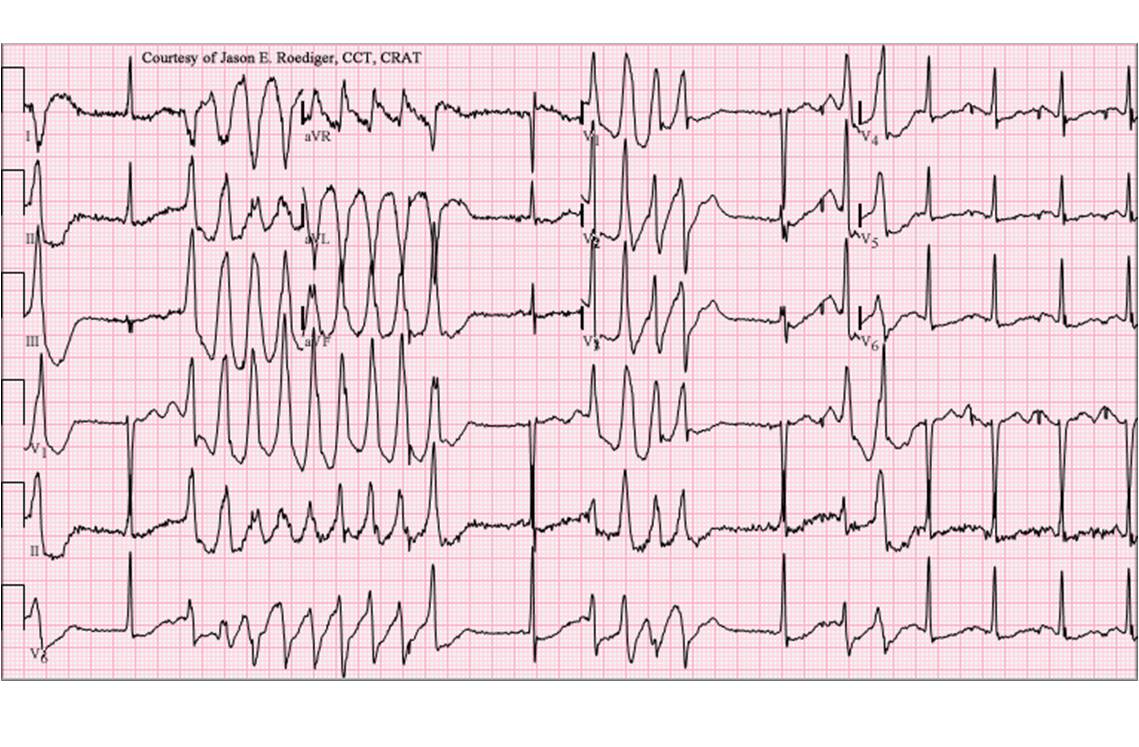 Le syndrome du QT long est associé à un risque élevé de torsades de pointe (ECG ci-dessous) ou de fibrillation ventriculaire (illustration @ Jer5150, Wikimedia).