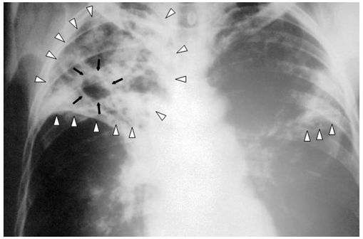 Radiographie thoracique d'un patient atteint d'une tuberculose à un stade avancé (photo @ Wikimedia).
