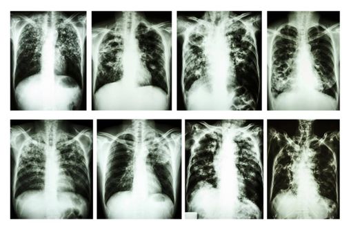 Clichés radiographiques de tuberculose.