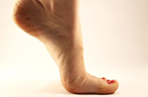 L'exercice physique adapté améliore la cicatrisation des ulcères de jambe veineux (illustration).
