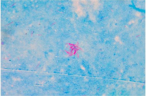 Mycobacterium tuberculosis (en rose sur cette photo au microscope).
