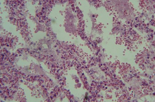 Coupe histologique montrant les cellules alvéolo-capillaires endommagées dans le cadre d’un syndrome de détresse respiratoire aiguë (illustration @Strolch sur Wikimedia).