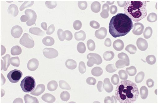 Frottis sanguin d'un patient atteint par la maladie de Vaquez (photo @AFIP Atlas of Tumor Pathology, sur Wikimedia).