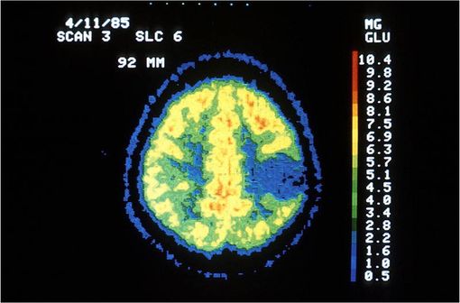 Images au PET Scan d'un astrocytome (illustration @Dr Giovanni Di Chiro - National Institute of Neurologic, sur Wikimedia)