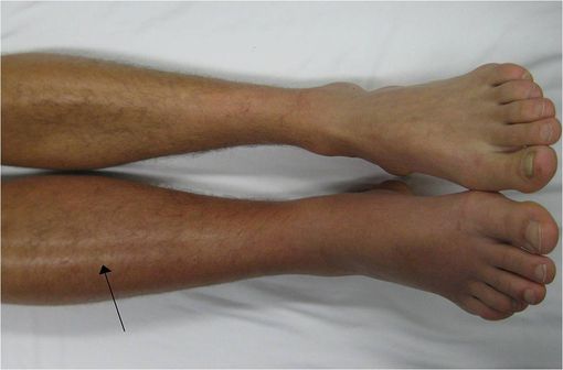 Thrombose veineuse profonde dans la jambe droite, avec rougeur et inflammation (illustration @James Heilman sur Wikimedia).