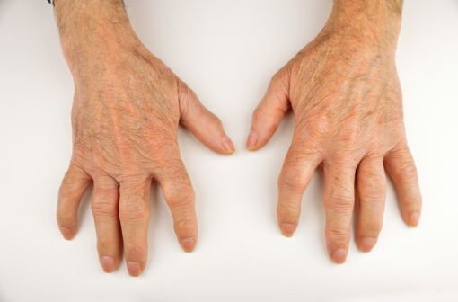 Mains déformées par des lésions de polyarthrite rhumatoïde (illustration).