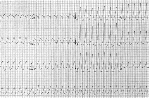 Electrocardiogramme d'une tachycardie ventriculaire (illustration@Karthik Sheka, M.D., sur Wikimedia).
