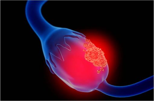 Représentation en 3D d'un cancer de l'ovaire (illustration).