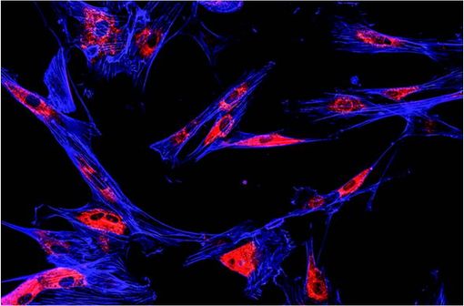 Cellules de mélanome en imagerie par immunofluorescence (illustration)