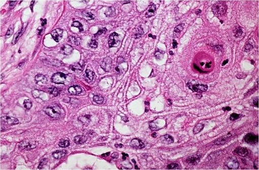 Coupe histologique d'un carcinome à cellules squameuses, un type de carcinome non à petites cellules (illustration @AFIP - PEIR Digital Library, sur Wikimedia).