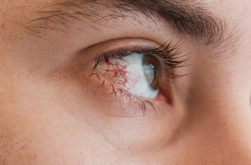 Lésions de kératite sur un œil humain. width=