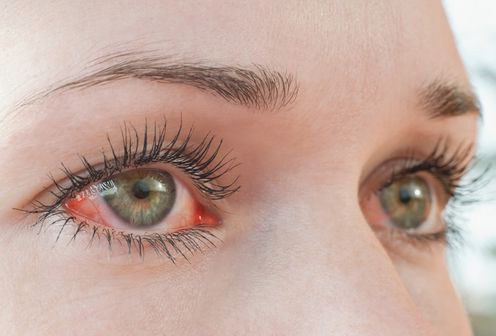 Inflammation du segment antérieur d'un œil.