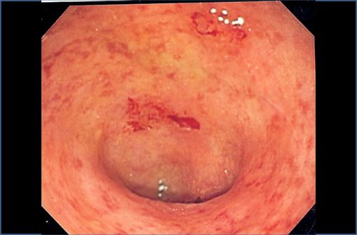 <p>Côlon sigmoïde atteint de rectocolite hémorragique (illustration @UC granularity sur Wikimedia).</p>