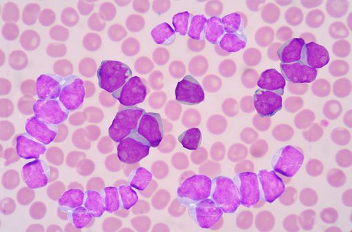 <p>Prolifération dans le sang de cellules leucémiques ou blastes.</p>