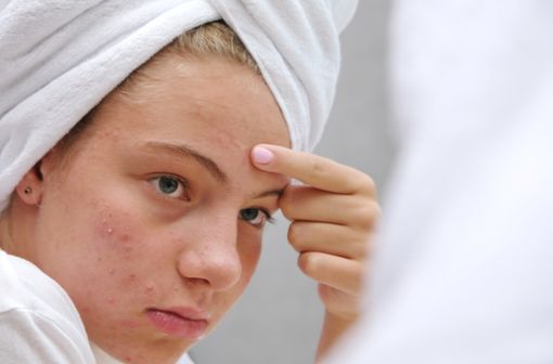 Lésions d'acné sur le visage d'une adolescente.