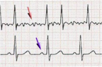Fibrillation auriculaire : trémulations de la ligne iso-électrique (flèche rouge), ECG normal (rythme sinusal) : onde P (flèche violette) [illustration @J. Heuser sur Wikimédia).