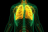 Le cancer bronchique non à petites cellules (CBNPC) représente près de 85 % de l’ensemble des cancers du poumon (illustration).