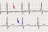 Fibrillation auriculaire : trémulations de la ligne iso-électrique (flèche rouge), ECG normal (rythme sinusal) : onde P (flèche violette) [illustration @J. Heuser sur Wikimédia).