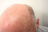 Lésions de kératose actinique sur la peau du crâne d'un homme chauve (illustration @Future FamDoc sur Wikimedia).
