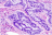 Vue histopathologique de cellules cancéreuses du colon (photo @ GNU Free Documentation License, sur Wikimedia).