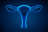 L'endométriose correspond à la présence de muqueuse utérine en dehors de la cavité de l'utérus (illustration). 